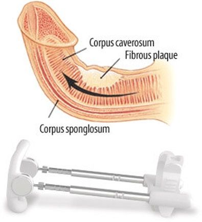 correct penis curvature